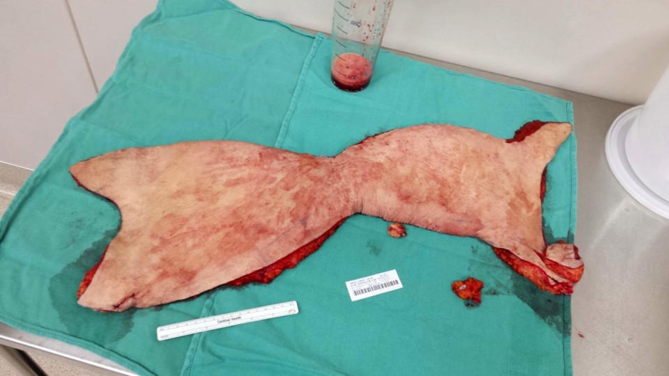 美国妞减肥皮肤松弛 斥巨资割掉腹部8斤肉